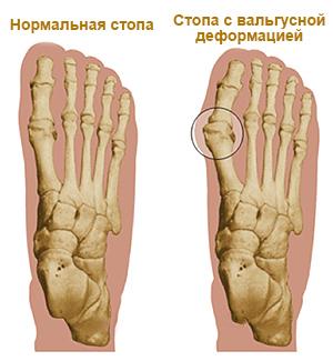 Фото заболевания большого пальца стопы
