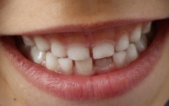 Что делать, если у ребёнка на зубах появился чёрный налёт? Советы стоматолога-ортодонта