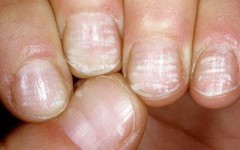 Белые пятна на ногтях – норма или патология?