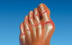 Причины роста косточки на большом пальце ноги – лечение косточки большого пальца, как её убрать