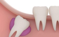 Зубы мудрости: нужно ли их удалять, и как за ними ухаживать?