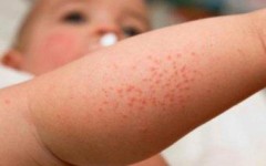 Красные пятна и раздражения на коже ребенка – первая помощь и необходимое лечение