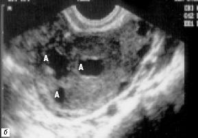 Photo ultrasound - 1 week of pregnancy