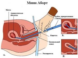 Мини-аборт  (вакуумный аборт) производится в сроки до 6 недель