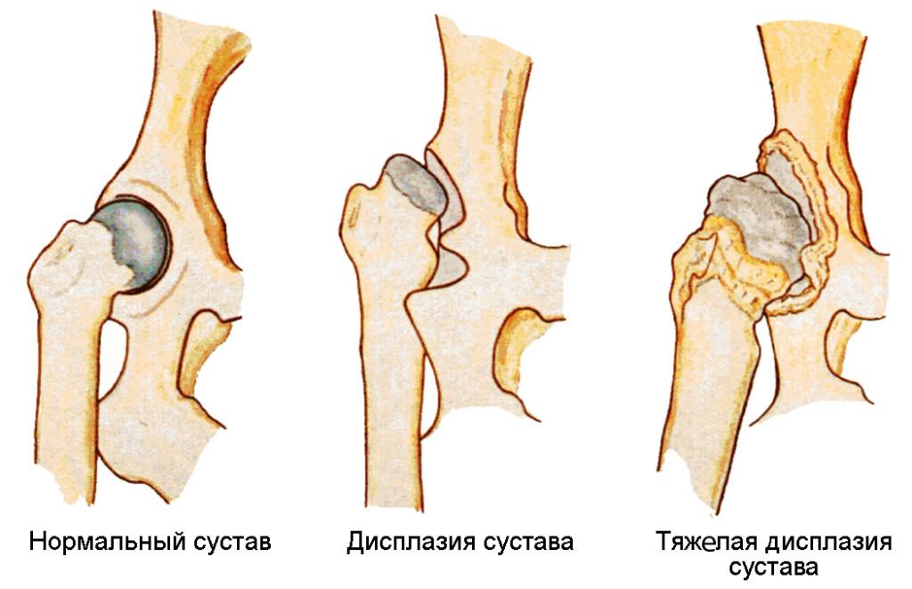 Дисплазия тазобедренного сустава у новорожденных