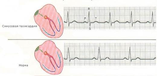 Types of tachycardia