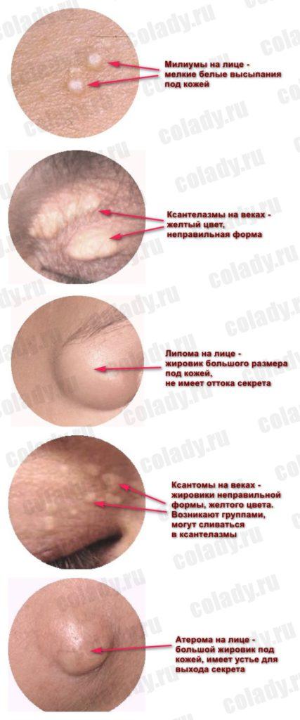 Fats on the face - causes, types of wen