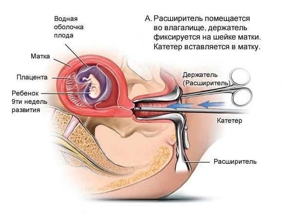 Аборт Аборт